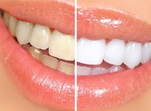 The-Top-8-Remedies-to-Turn-Yellow-Teeth