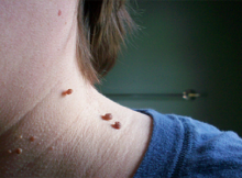 You Only Need One Ingredient To Remove Skin Tags