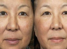 This-2-Ingredient-Home-Remedy-Removes-Freckles-Stains-and-Hyperpigmentation