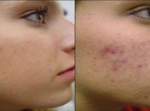 This-Tea-Will-Help-You-Get-Rid-Of-Acne-And-Pimples