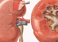 Kidney-Damaging-Habits