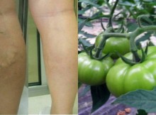 Treat-Varicose-Veins-With-This-Russian-Recipe–-Immediately-Visible-Results