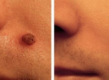 Remove-the-Moles-on-Your-Skin-with-Only-One-Ingredient