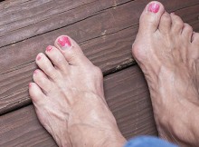 Feet with severe bunions