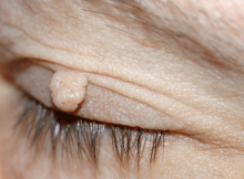 skin-tags-eye-750