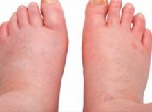 Feet-Swelling