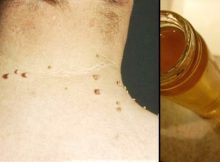 skin-tags-acv