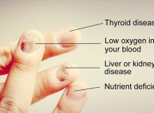 10-Nail-Symptoms-and-What-They-Mean-for-Your-Health