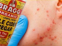 Put-Apple-Cider-Vinegar-on-Your-Face-and-SEE-What-Happens-to-Toxins-Eczema
