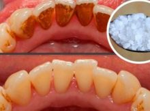 That-Nasty-Plaque-And-Tartar-Buildup-at-Home