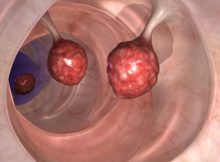 This-Kills-93-of-Colon-Cancer-Cells-in-Just-Two-Days