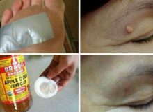 Remove-Warts-Dark-Spots-Blackheads-And-Skin-Tags-Quickly-And-Effectively-With-These-Natural-Remedies