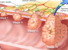 The-Cancer-Dies-When-You-Eat-These-Five-Foods-It’s-Time-To-Start-Eating-Them