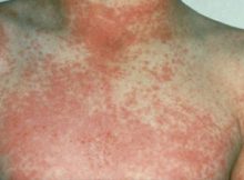 scarlet-fever1
