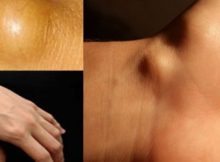 lipoma