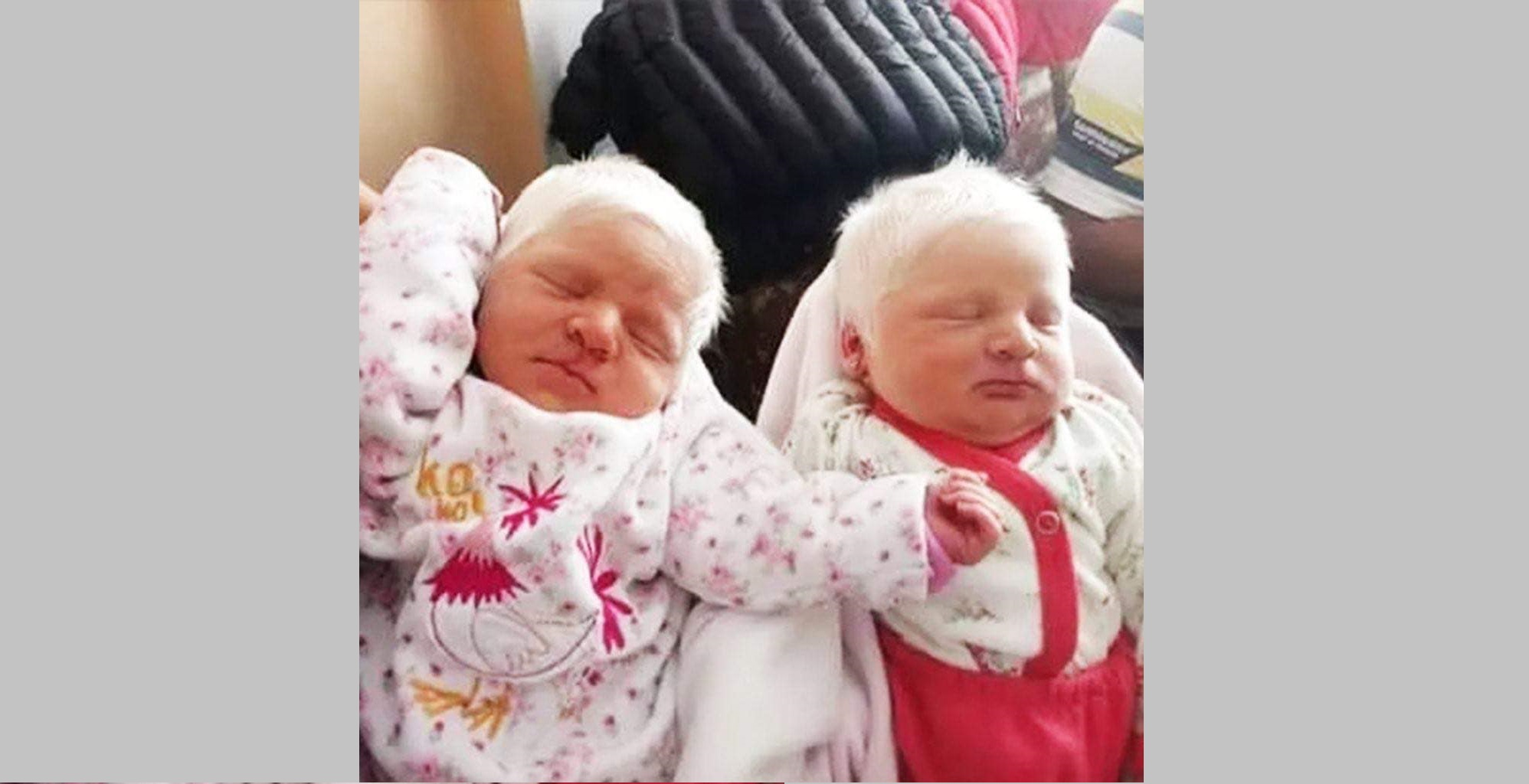 The First Ever Albino Twins Born In Argentina Will Leave You In Awe